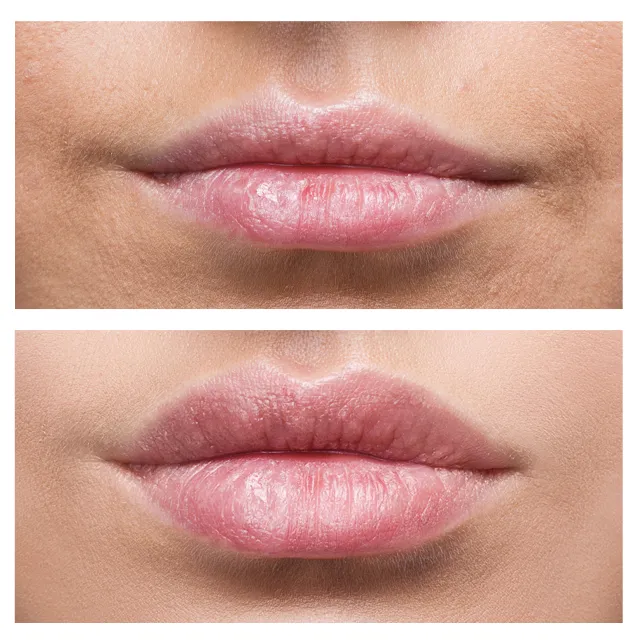 Lip before and after 1